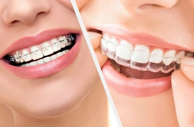 Braces & Aligners
