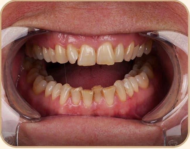 Smile Makeover - Before treatment at Cosmodocs