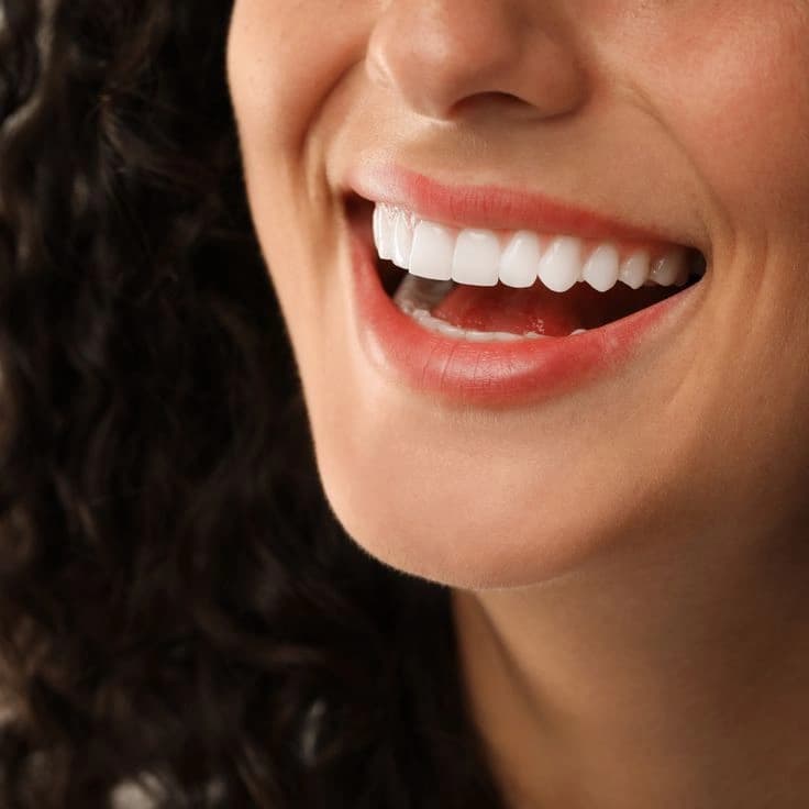 Smile Makeover