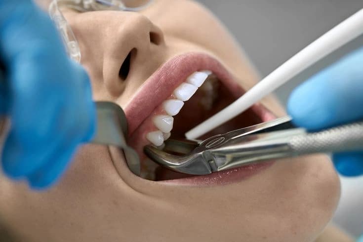 Painless Wisdom Tooth Extraction