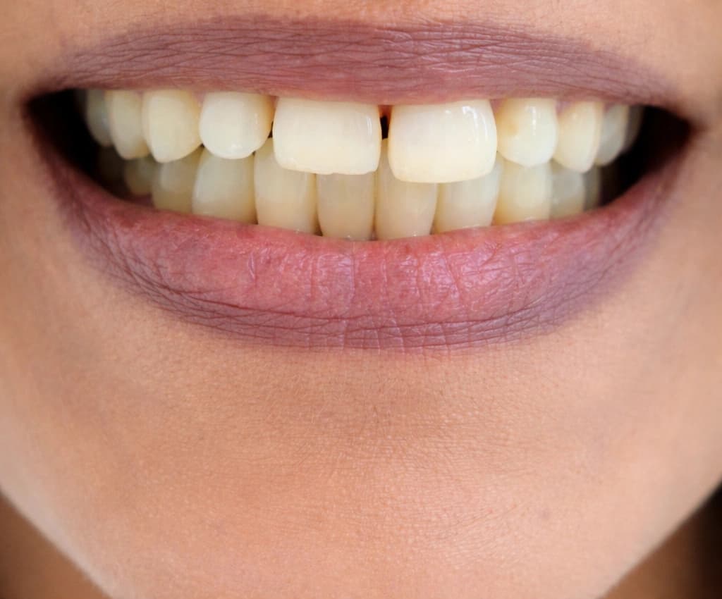 Dental Veneers - After treatment at Cosmodocs