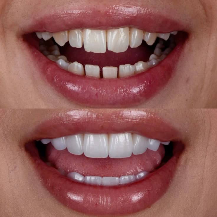 Veneers